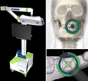 X-Guide™ system with dynamic 3D navigation delivers interactive, turn-by-turn guidance providing the ability to improve the precision and accuracy of implant position, angle and depth.